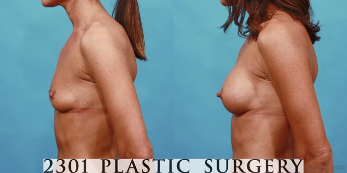 Before & After Silicone Implants Case 557 View #3 View in Fort Worth, Plano, & Frisco, Texas