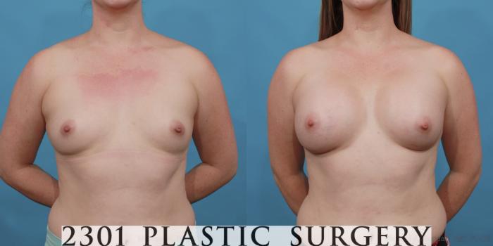 Before & After Silicone Implants Case 559 View #1 View in Fort Worth, Plano, & Frisco, Texas