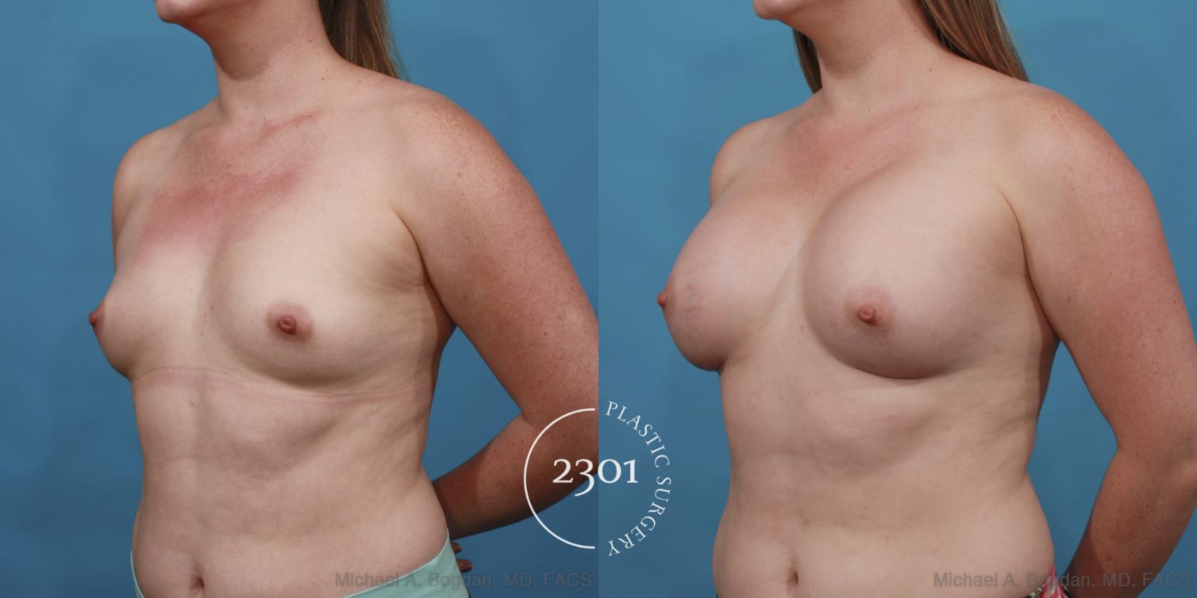 Before & After Silicone Implants Case 559 View #2 View in Fort Worth, Plano, & Frisco, Texas