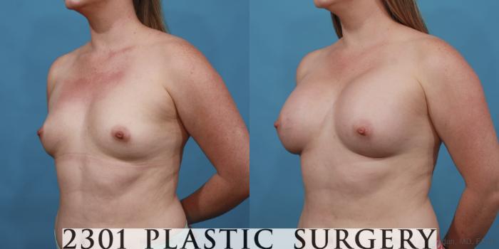Before & After Breast Augmentation Case 559 View #2 View in Fort Worth, Plano, & Frisco, Texas