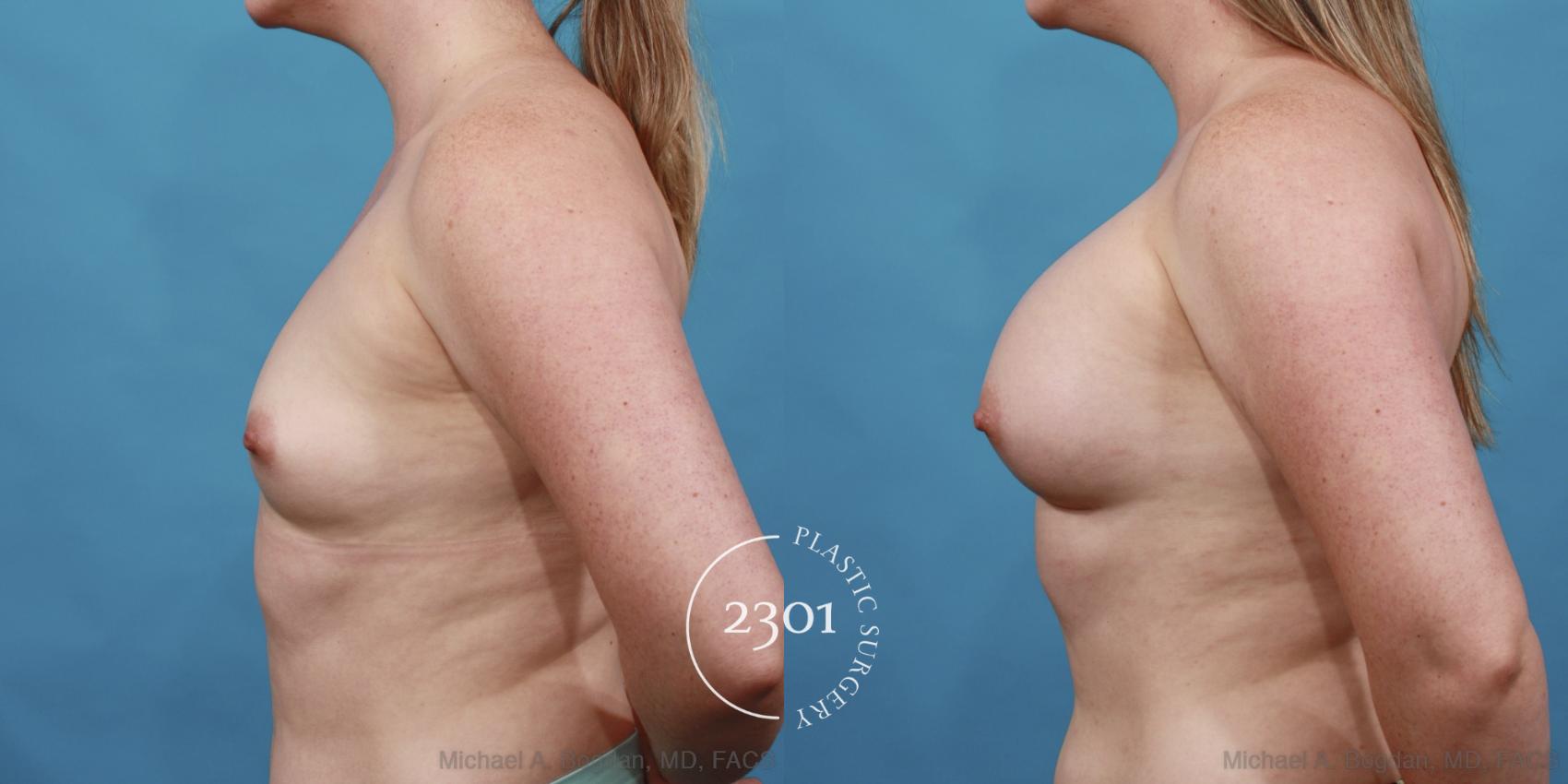 Before & After Silicone Implants Case 559 View #3 View in Fort Worth, Plano, & Frisco, Texas