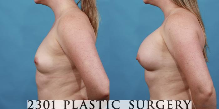 Before & After Breast Augmentation Case 559 View #3 View in Fort Worth, Plano, & Frisco, Texas
