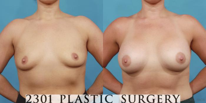 Before & After Silicone Implants Case 562 View #1 View in Fort Worth, Plano, & Frisco, Texas