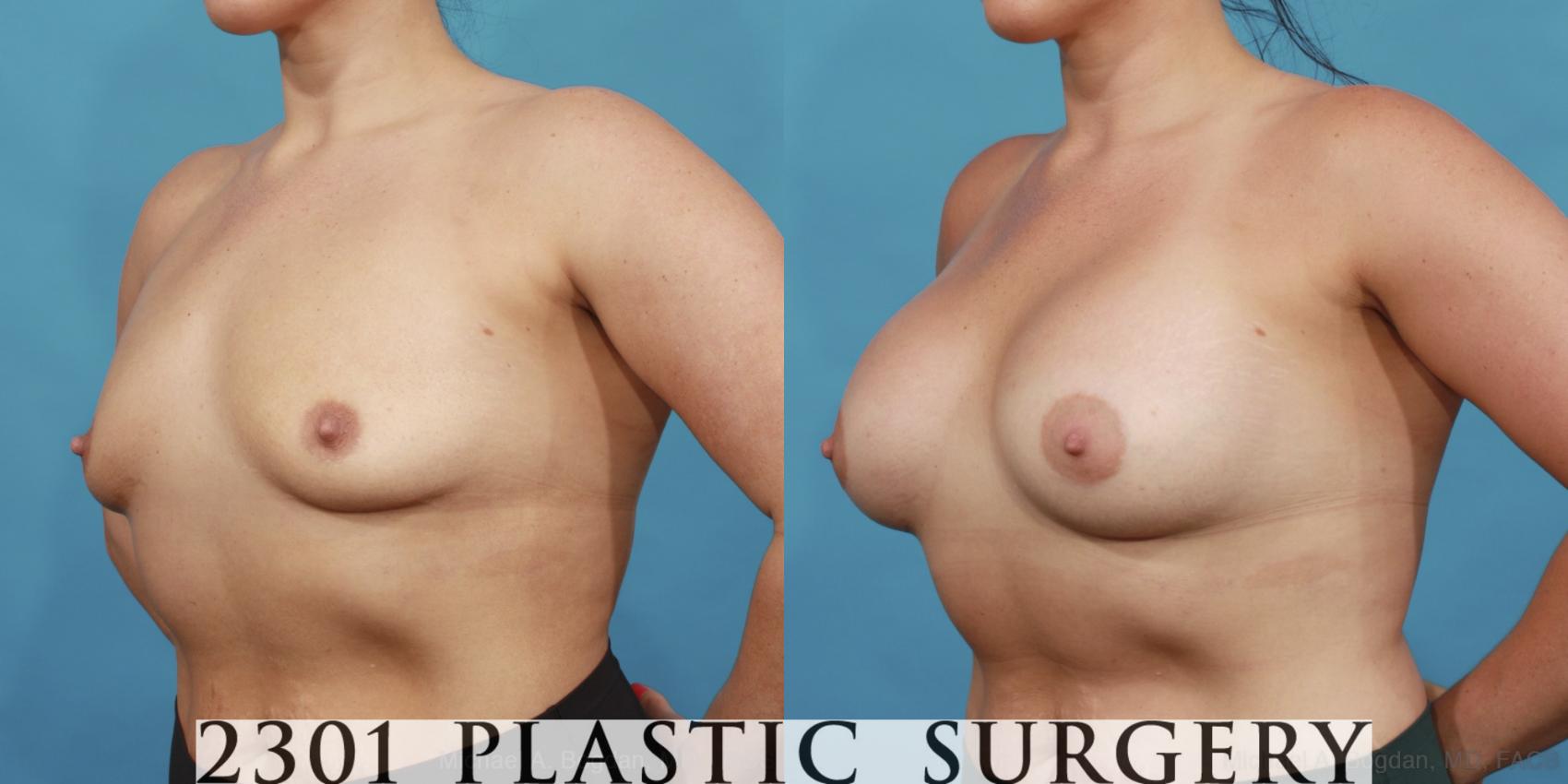 Before & After Silicone Implants Case 562 View #2 View in Fort Worth & Frisco, Texas