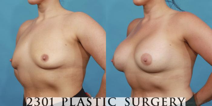 Before & After Breast Augmentation Case 562 View #2 View in Fort Worth, Plano, & Frisco, Texas
