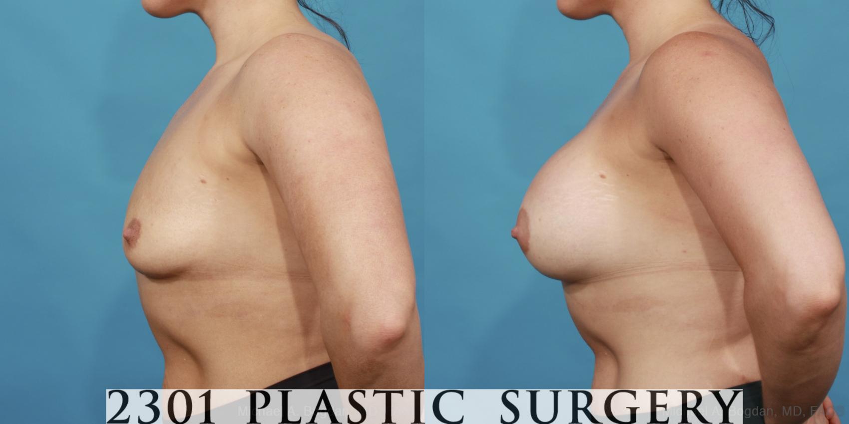 Before & After Silicone Implants Case 562 View #3 View in Fort Worth & Frisco, Texas