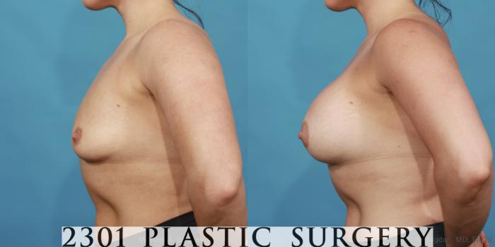 Before & After Silicone Implants Case 562 View #3 View in Fort Worth, Plano, & Frisco, Texas