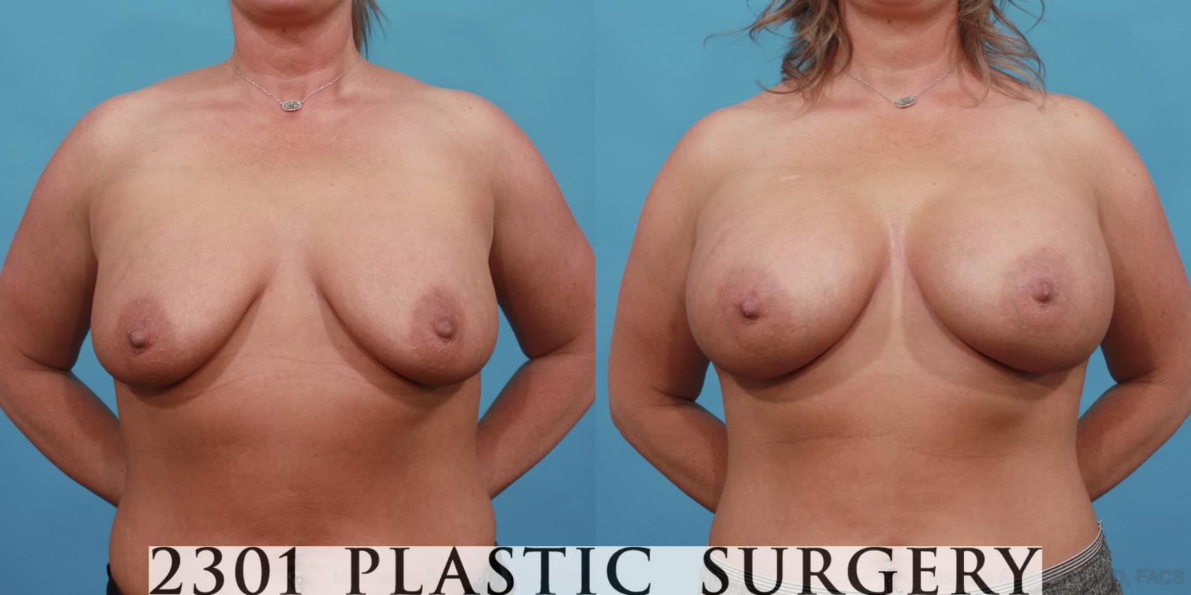Before & After Silicone Implants Case 566 View #1 View in Fort Worth & Frisco, Texas