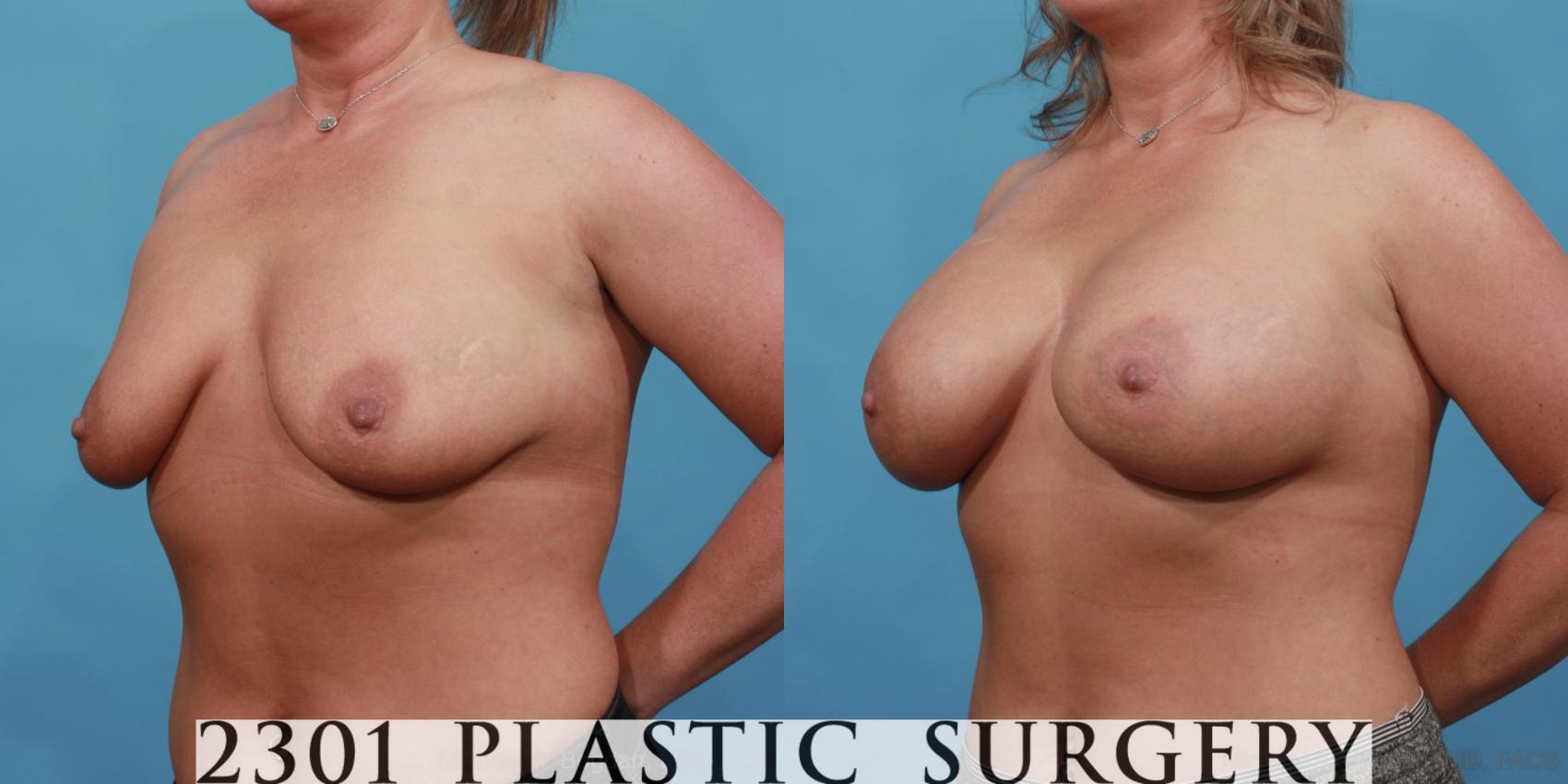 Before & After Silicone Implants Case 566 View #2 View in Fort Worth & Frisco, Texas