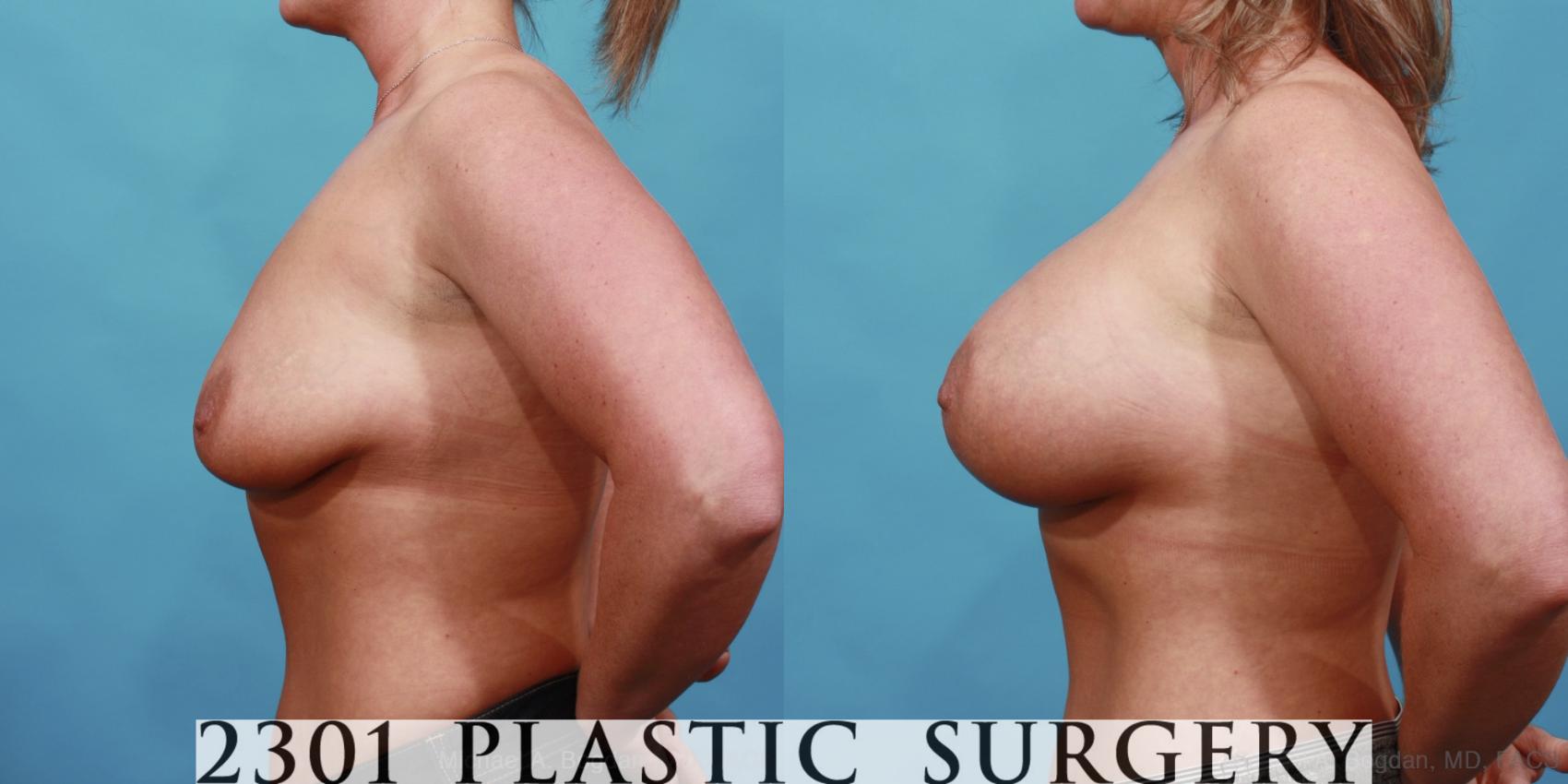 Before & After Silicone Implants Case 566 View #3 View in Fort Worth & Frisco, Texas