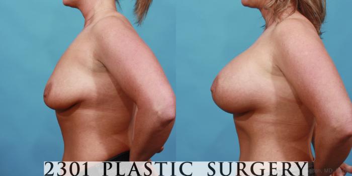 Before & After Silicone Implants Case 566 View #3 View in Fort Worth, Plano, & Frisco, Texas