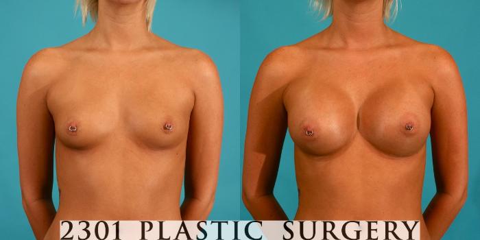 Before & After Silicone Implants Case 58 View #1 View in Fort Worth, Plano, & Frisco, Texas