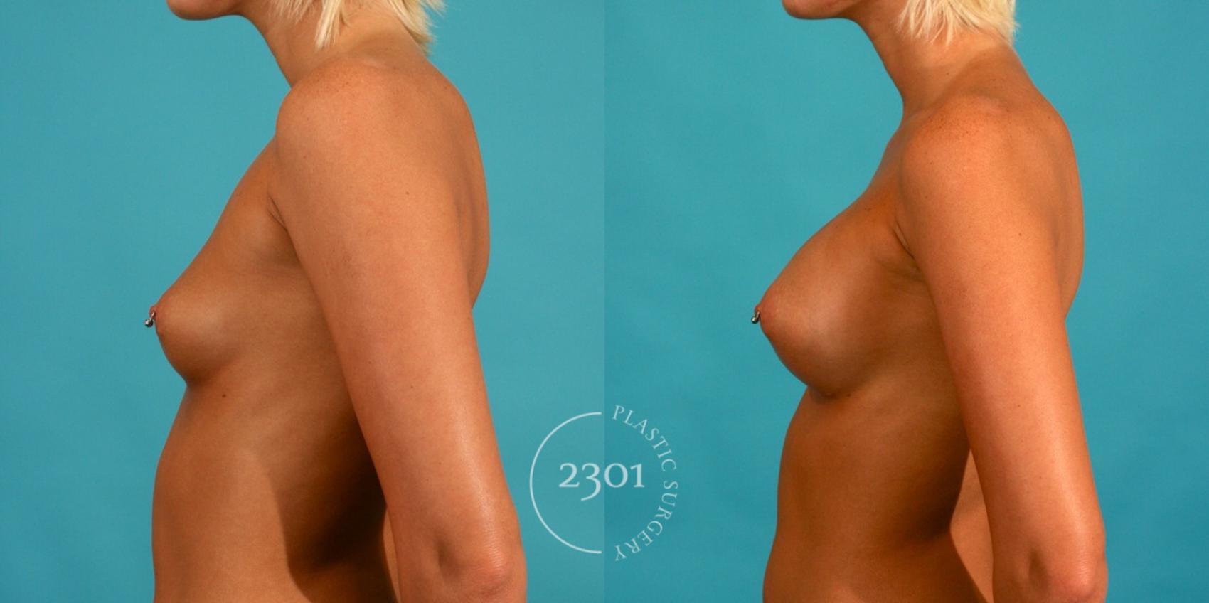 Before & After Silicone Implants Case 58 View #2 View in Fort Worth, Plano, & Frisco, Texas