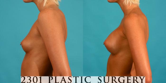 Before & After Silicone Implants Case 58 View #2 View in Fort Worth, Plano, & Frisco, Texas