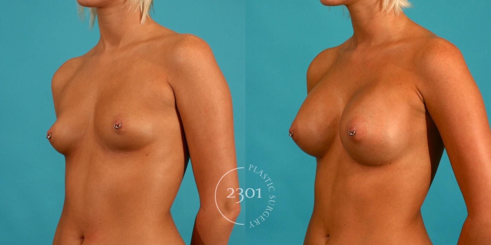 Before & After Silicone Implants Case 58 View #3 View in Fort Worth, Plano, & Frisco, Texas