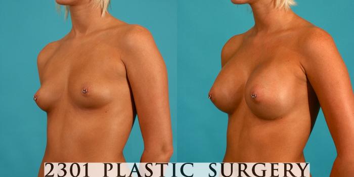 Before & After Silicone Implants Case 58 View #3 View in Fort Worth, Plano, & Frisco, Texas