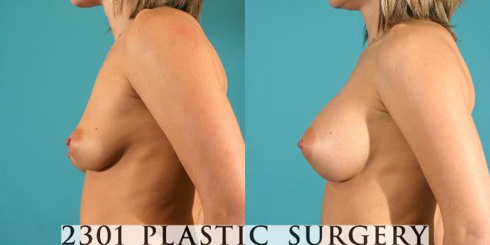 Before & After Silicone Implants Case 6 View #2 View in Fort Worth, Plano, & Frisco, Texas