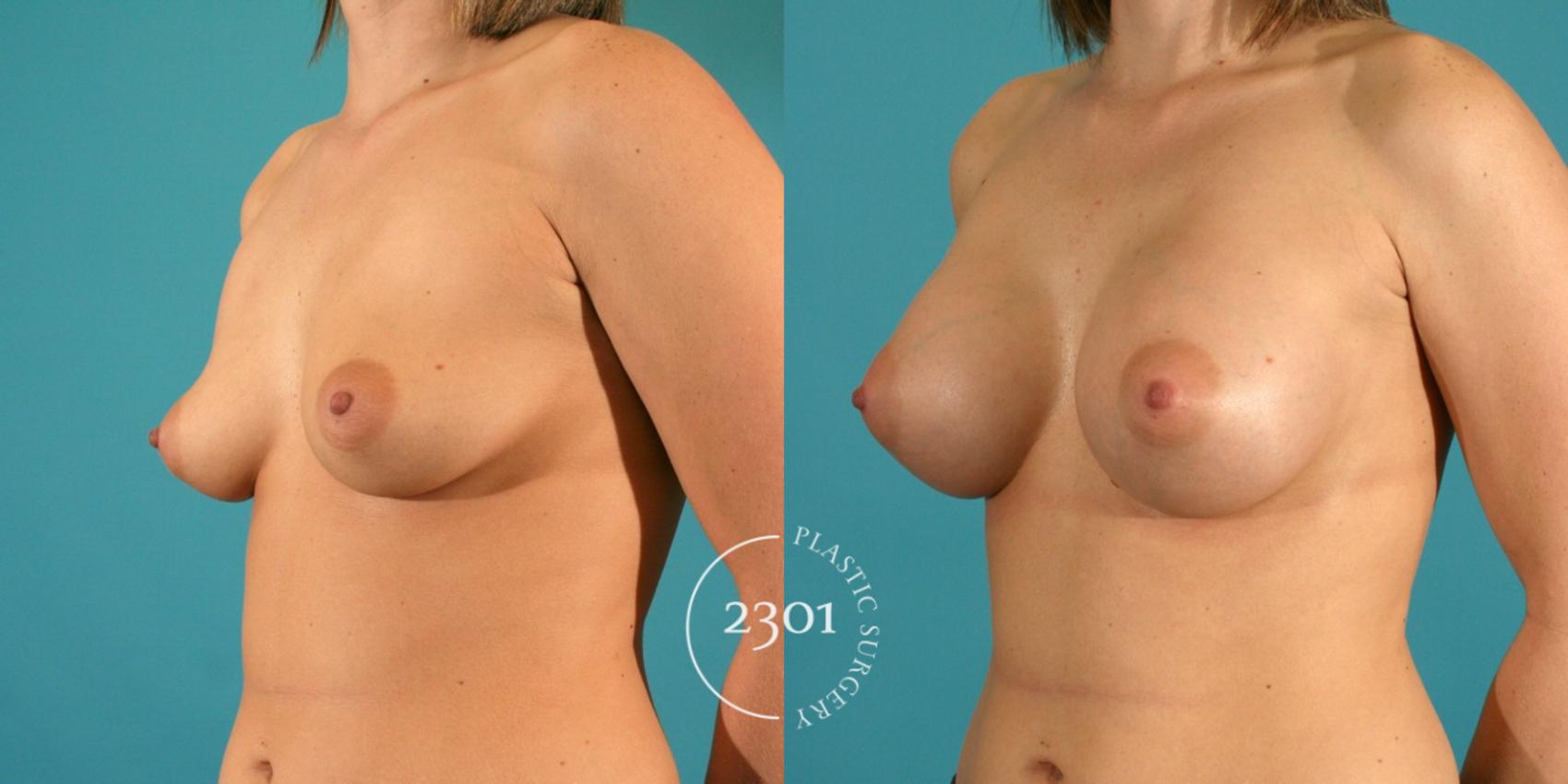 Before & After Silicone Implants Case 6 View #3 View in Fort Worth, Plano, & Frisco, Texas