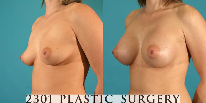 Before & After Silicone Implants Case 6 View #3 View in Fort Worth, Plano, & Frisco, Texas