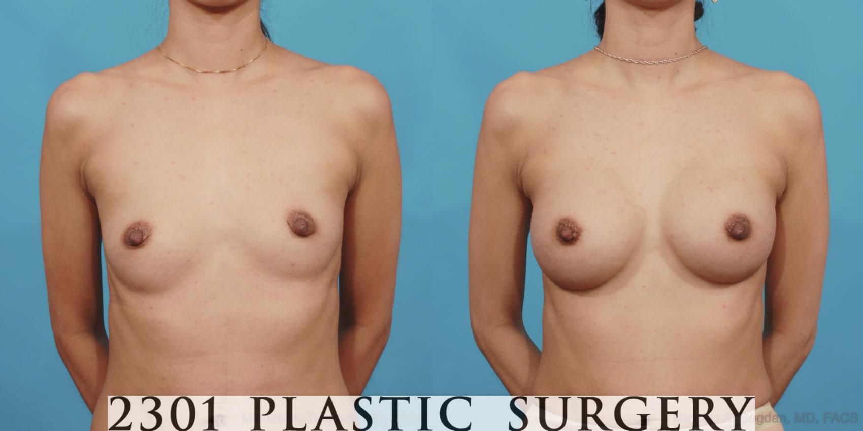 Before & After Breast Augmentation Case 601 View #1 View in Fort Worth, Plano, & Frisco, Texas