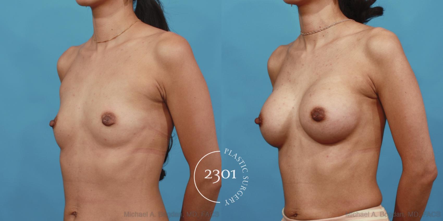 Before & After Silicone Implants Case 601 View #2 View in Fort Worth, Plano, & Frisco, Texas