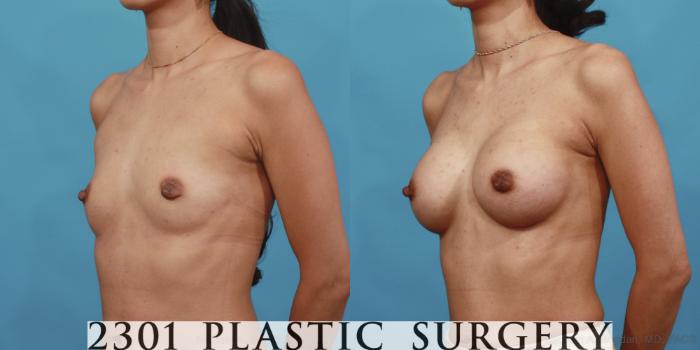 Before & After Silicone Implants Case 601 View #2 View in Fort Worth, Plano, & Frisco, Texas