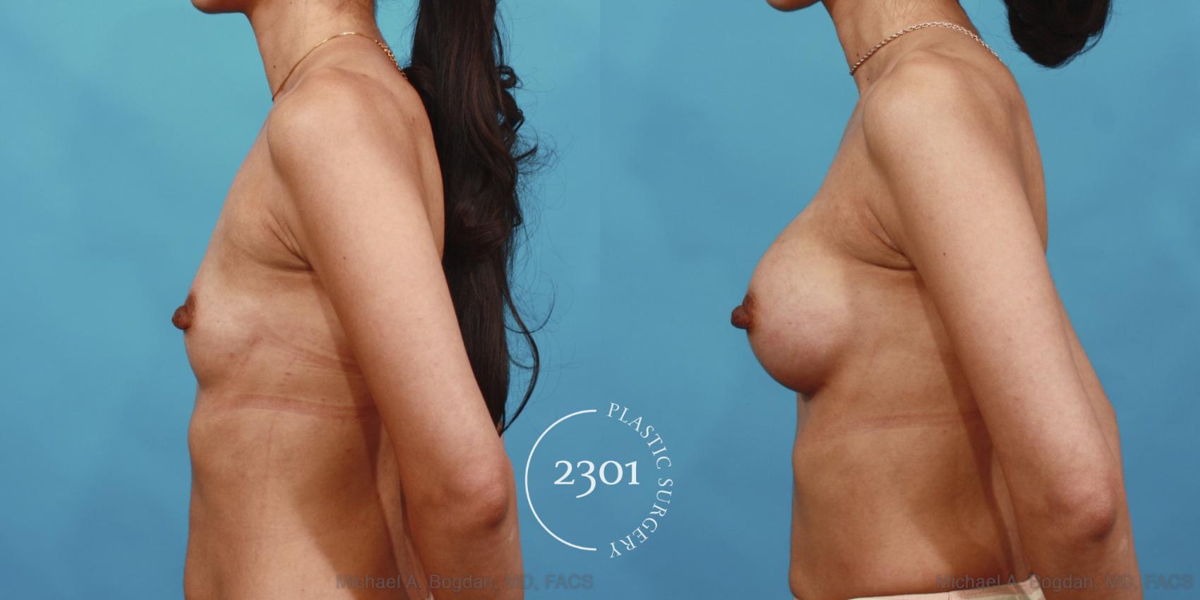 Before & After Silicone Implants Case 601 View #3 View in Fort Worth, Plano, & Frisco, Texas