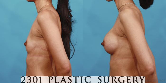 Before & After Breast Augmentation Case 601 View #3 View in Fort Worth, Plano, & Frisco, Texas
