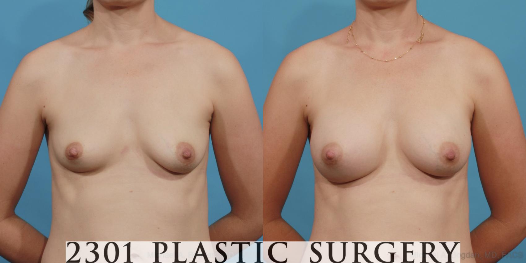 Before & After Silicone Implants Case 602 View #1 View in Fort Worth, Plano, & Frisco, Texas