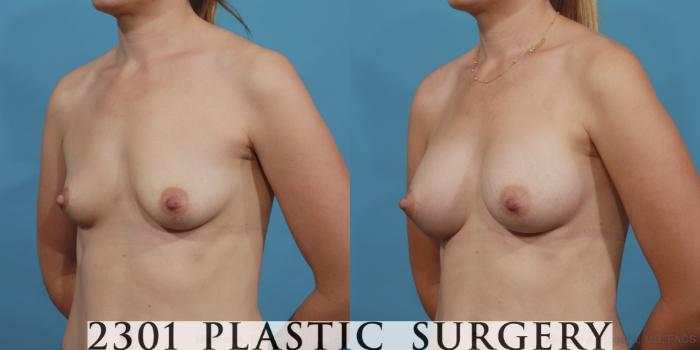 Before & After Silicone Implants Case 602 View #2 View in Fort Worth, Plano, & Frisco, Texas