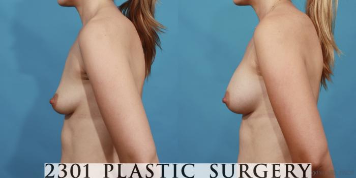 Before & After Silicone Implants Case 602 View #3 View in Fort Worth, Plano, & Frisco, Texas