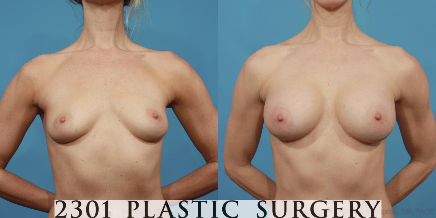 Before & After Silicone Implants Case 603 View #1 View in Fort Worth & Frisco, Texas