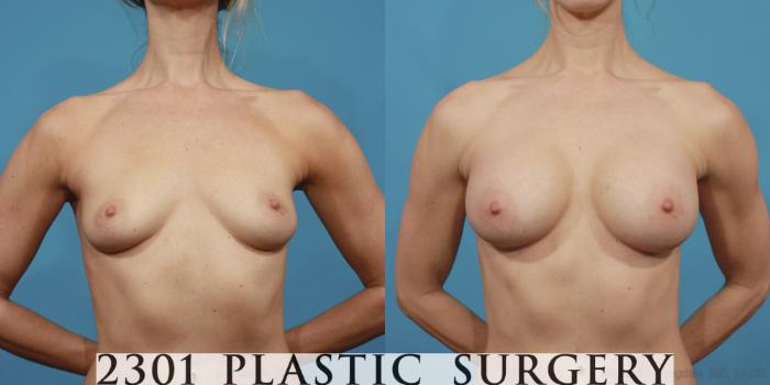 Before & After Silicone Implants Case 603 View #1 View in Fort Worth, Plano, & Frisco, Texas