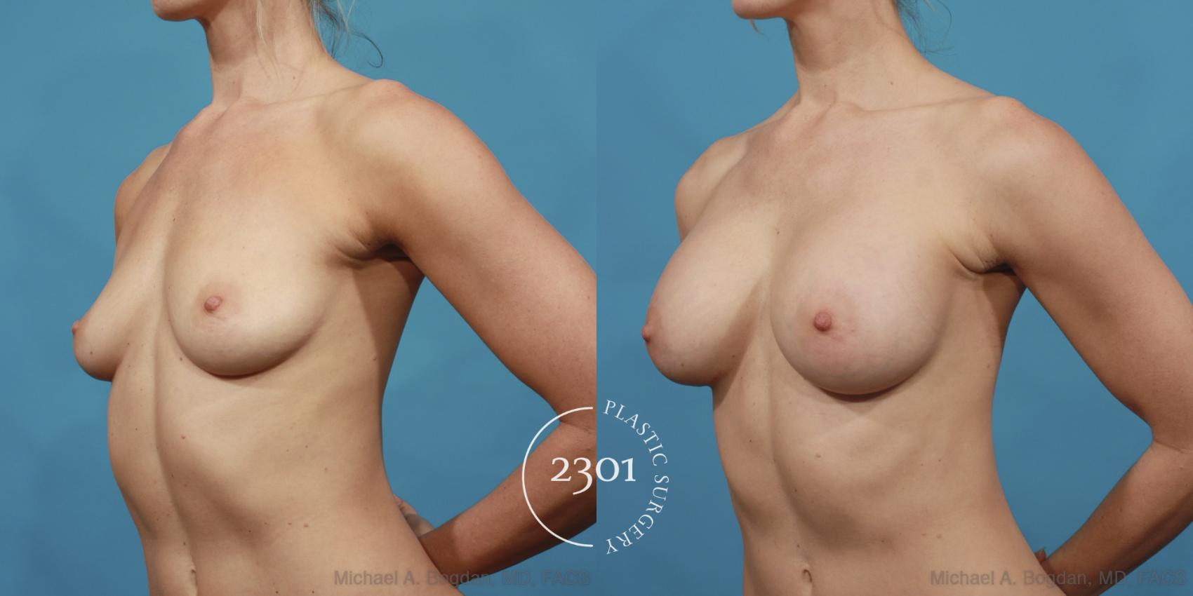 Before & After Silicone Implants Case 603 View #2 View in Fort Worth, Plano, & Frisco, Texas