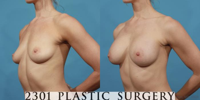 Before & After Silicone Implants Case 603 View #2 View in Fort Worth, Plano, & Frisco, Texas