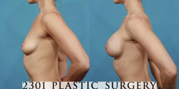Before & After Silicone Implants Case 603 View #3 View in Fort Worth, Plano, & Frisco, Texas