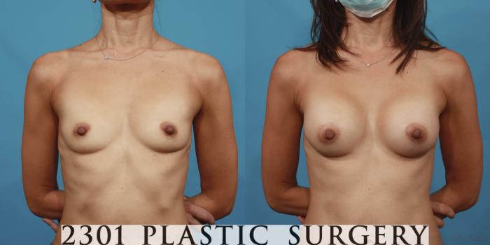 Before & After Silicone Implants Case 608 Front View in Fort Worth, Plano, & Frisco, Texas