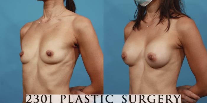 Before & After Silicone Implants Case 608 Left Oblique View in Fort Worth, Plano, & Frisco, Texas