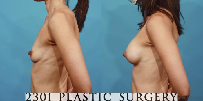 Before & After Silicone Implants Case 608 Left Side View in Fort Worth, Plano, & Frisco, Texas