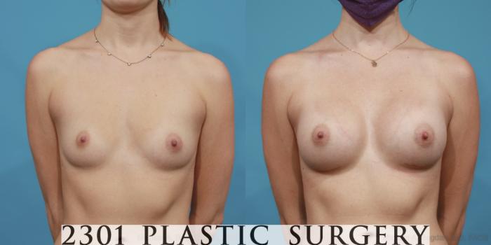 Before & After Breast Augmentation Case 609 Front View in Fort Worth, Plano, & Frisco, Texas