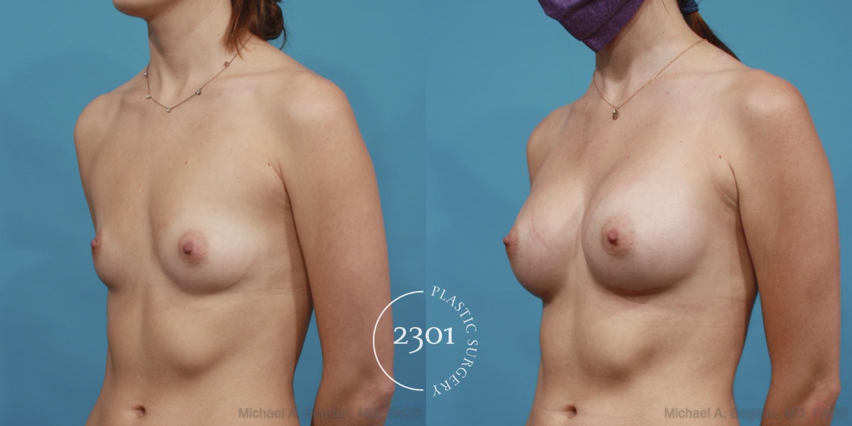 Before & After Silicone Implants Case 609 Left Oblique View in Fort Worth, Plano, & Frisco, Texas