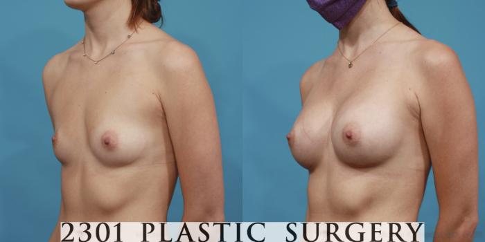 Before & After Breast Augmentation Case 609 Left Oblique View in Fort Worth, Plano, & Frisco, Texas