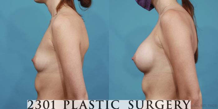Before & After Breast Augmentation Case 609 Left Side View in Fort Worth, Plano, & Frisco, Texas