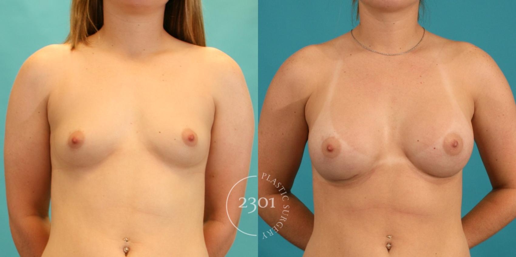 Before & After Silicone Implants Case 7 View #1 View in Fort Worth, Plano, & Frisco, Texas