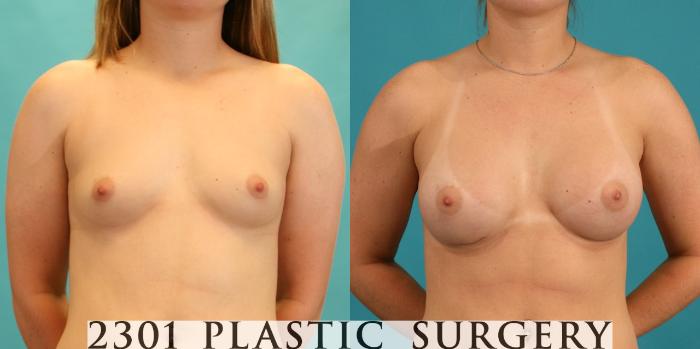 Before & After Silicone Implants Case 7 View #1 View in Fort Worth, Plano, & Frisco, Texas