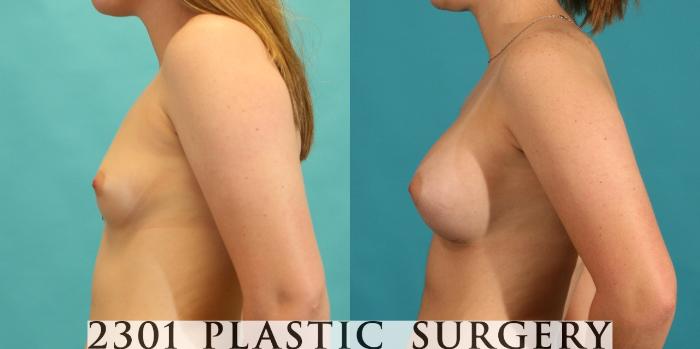 Before & After Silicone Implants Case 7 View #2 View in Fort Worth, Plano, & Frisco, Texas