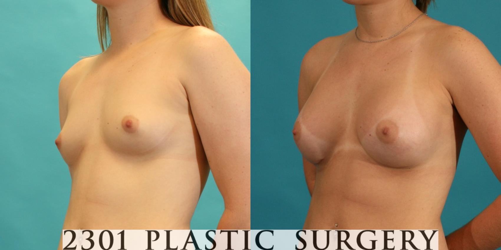 Before & After Silicone Implants Case 7 View #3 View in Fort Worth & Frisco, Texas
