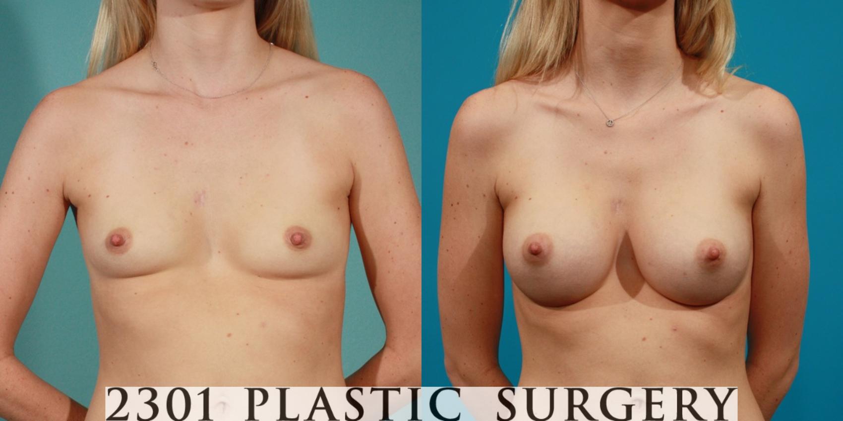 Before & After Breast Augmentation Case 79 View #1 View in Fort Worth, Plano, & Frisco, Texas