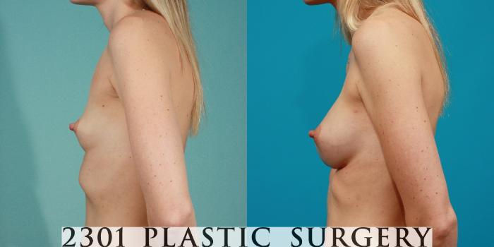 Before & After Breast Augmentation Case 79 View #2 View in Fort Worth, Plano, & Frisco, Texas