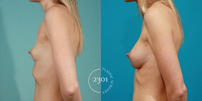 Before & After Breast Augmentation Case 79 View #2 View in Fort Worth, Plano, & Frisco, Texas